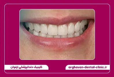 بستن فاصله با کامپوزیت بعد