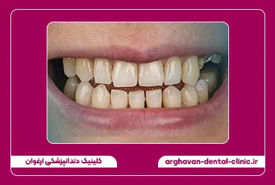 بستن فاصله با کامپوزیت قبل