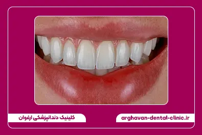 تعویض کامپوزیت تک رنگ به لبه شفاف بعد