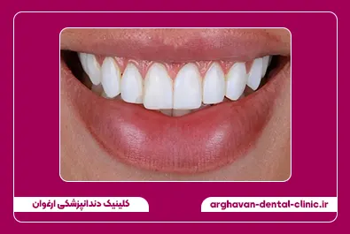 تعویض کامپوزیت تک رنگ به لبه شفاف قبل