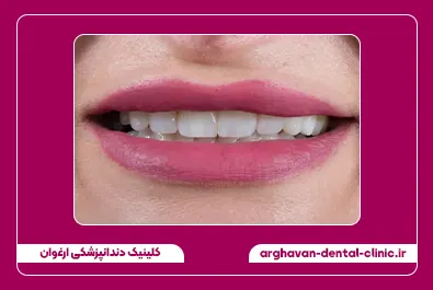 مرتب سازی و بستن فاصله با کامپوزیت بعد