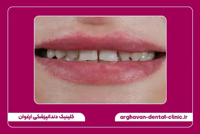 مرتب سازی و بستن فاصله با کامپوزیت قبل