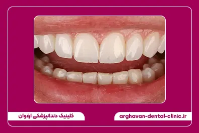 کامپوزیت زیبایی لبه شفاف بستن فاصله بعد