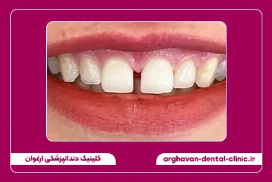 کامپوزیت زیبایی لبه شفاف بستن فاصله قبل