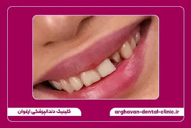 کامپوزیت قبل