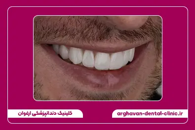 کامپوزیت بعد