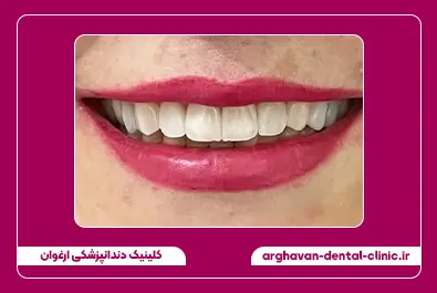 کامپوزیت زیبایی بعد