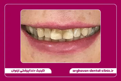 کامپوزیت زیبایی قبل