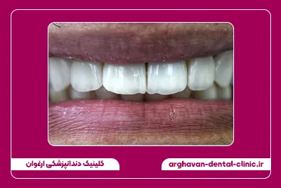 کامپوزیت زیبایی بعد