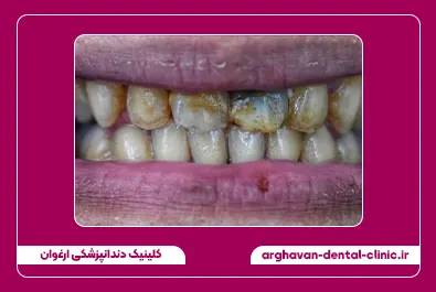 کامپوزیت زیبایی قبل