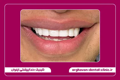 کامپوزیت زیبایی بعد