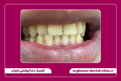 کامپوزیت زیبایی قبل