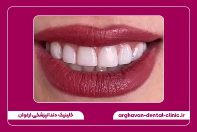 کامپوزیت زیبایی بعد