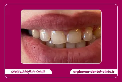 کامپوزیت زیبایی قبل