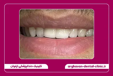 کامپوزیت زیبایی بعد