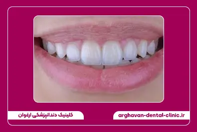 کامپوزیت لبه شفاف بعد