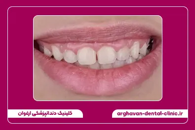 کامپوزیت لبه شفاف قبل