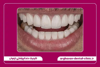 کامپوزیت لبه شفاف بعد