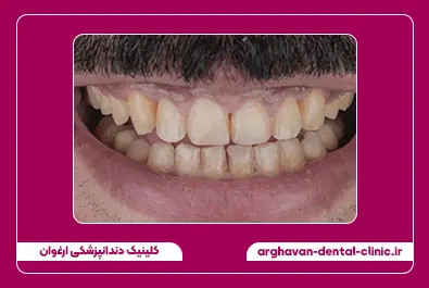 کامپوزیت لبه شفاف قبل