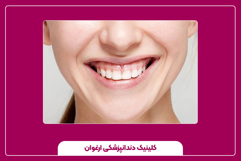 جدیدترین روش‌ درمان لبخند لثه‌ای