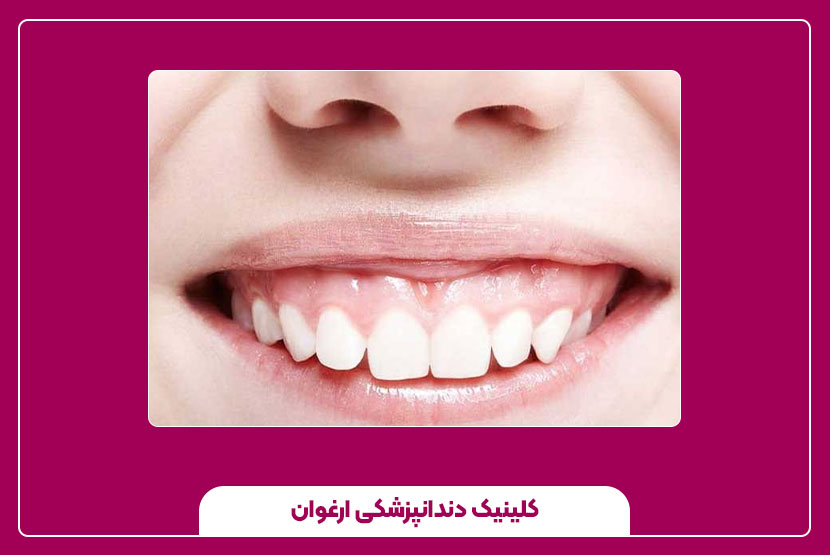 بهترین روش‌های درمان لبخند لثه‌ای در دندانپزشکی زیبایی