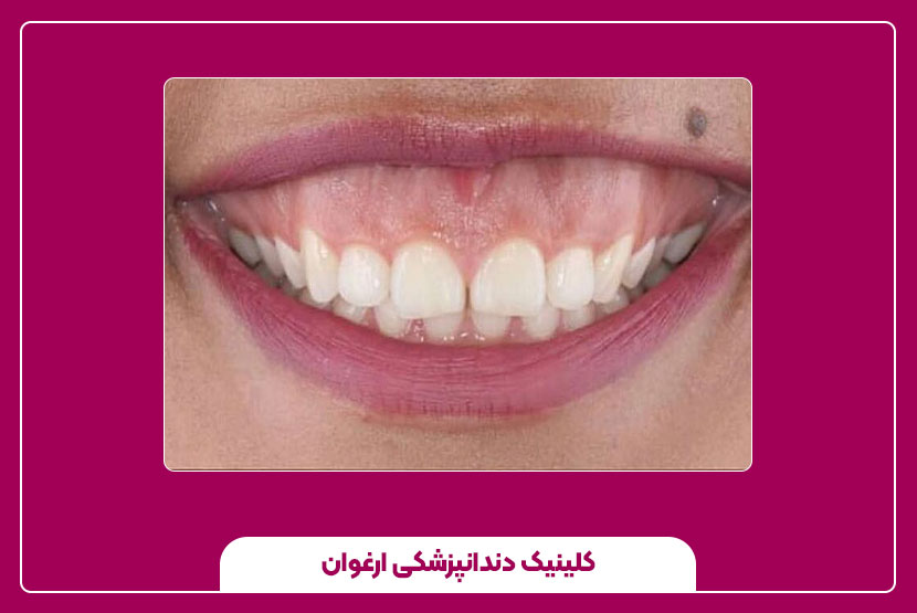 مقایسه روش‌های درمان لبخند لثه‌ای