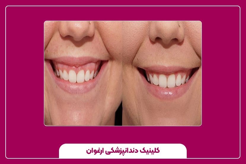 مراقبت‌ها، هزینه‌ها و ماندگاری درمان لبخند لثه‌ای